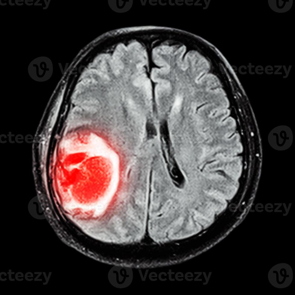 La risonanza magnetica mostra un tumore al cervello al lobo parietale destro del cervello foto