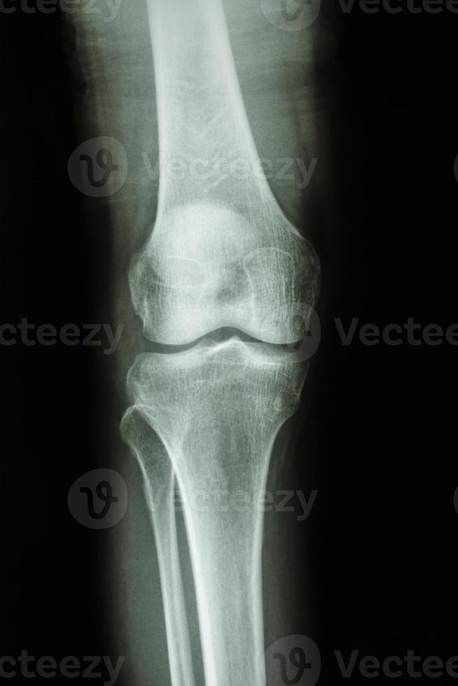 la vista ap del ginocchio a raggi x del film mostra la vista frontale dell'articolazione del ginocchio umano normale foto