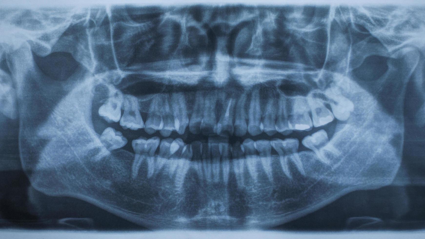 radiografia panoramica dentale foto