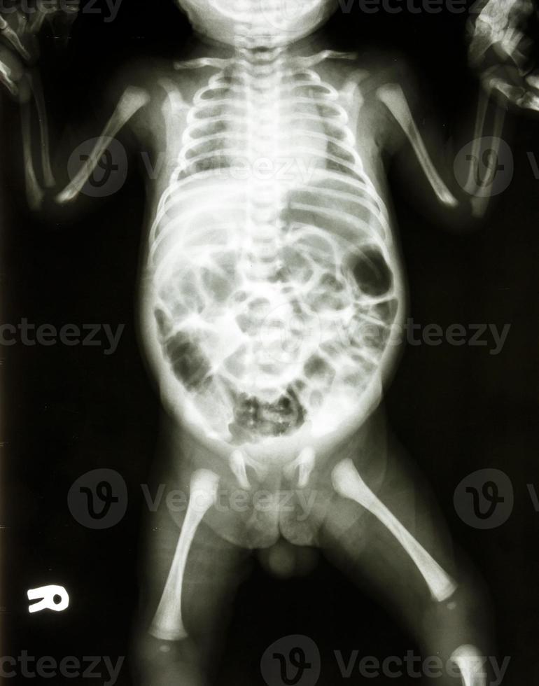 pellicola a raggi x mostra scheletro normale del bambino foto