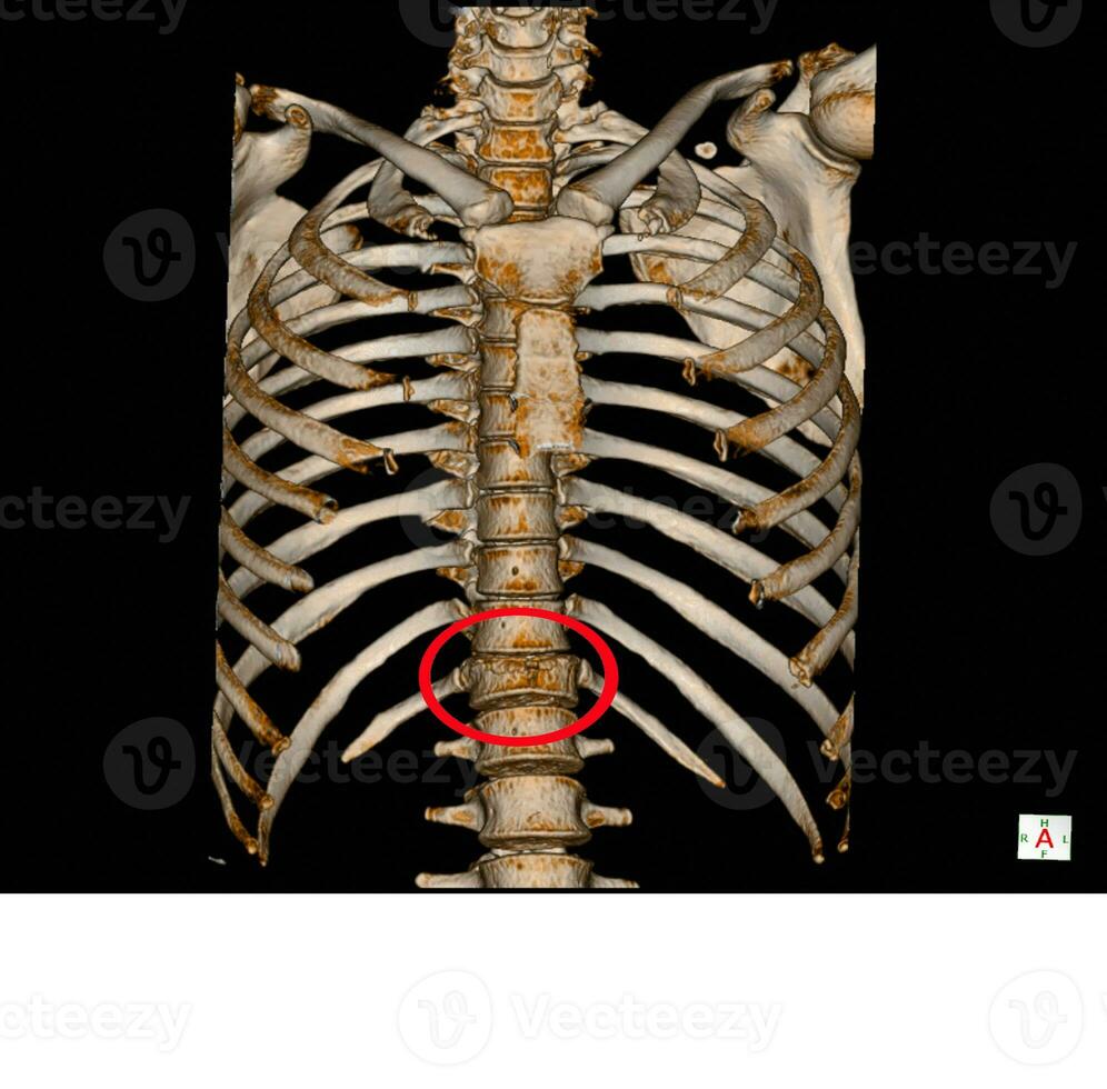 raggi X e ct scansione toracica colonna vertebrale foto