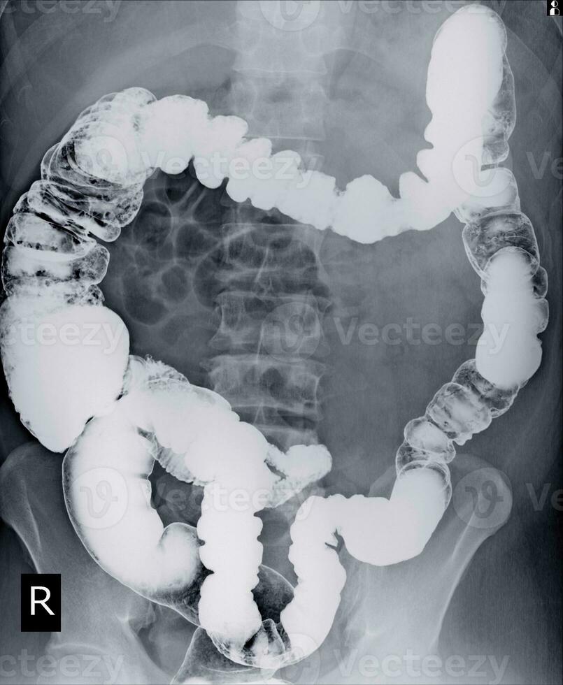 speciale visita medica bario clistere un' maschio 52 anno vecchio. foto