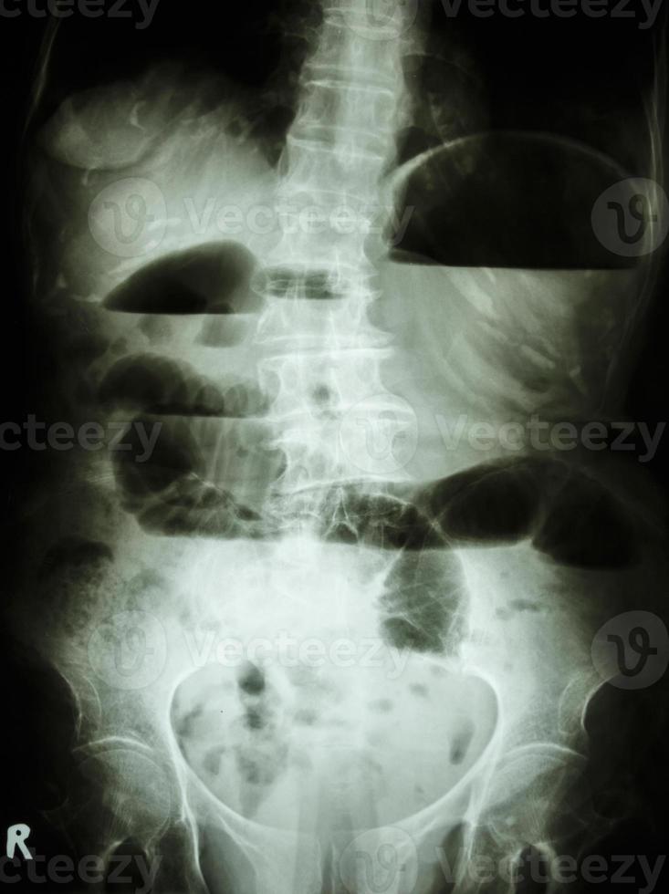 la pellicola radiografica dell'addome in posizione verticale mostra l'intestino tenue dilatato e il livello del fluido aria nell'intestino tenue a causa dell'ostruzione dell'intestino tenue foto