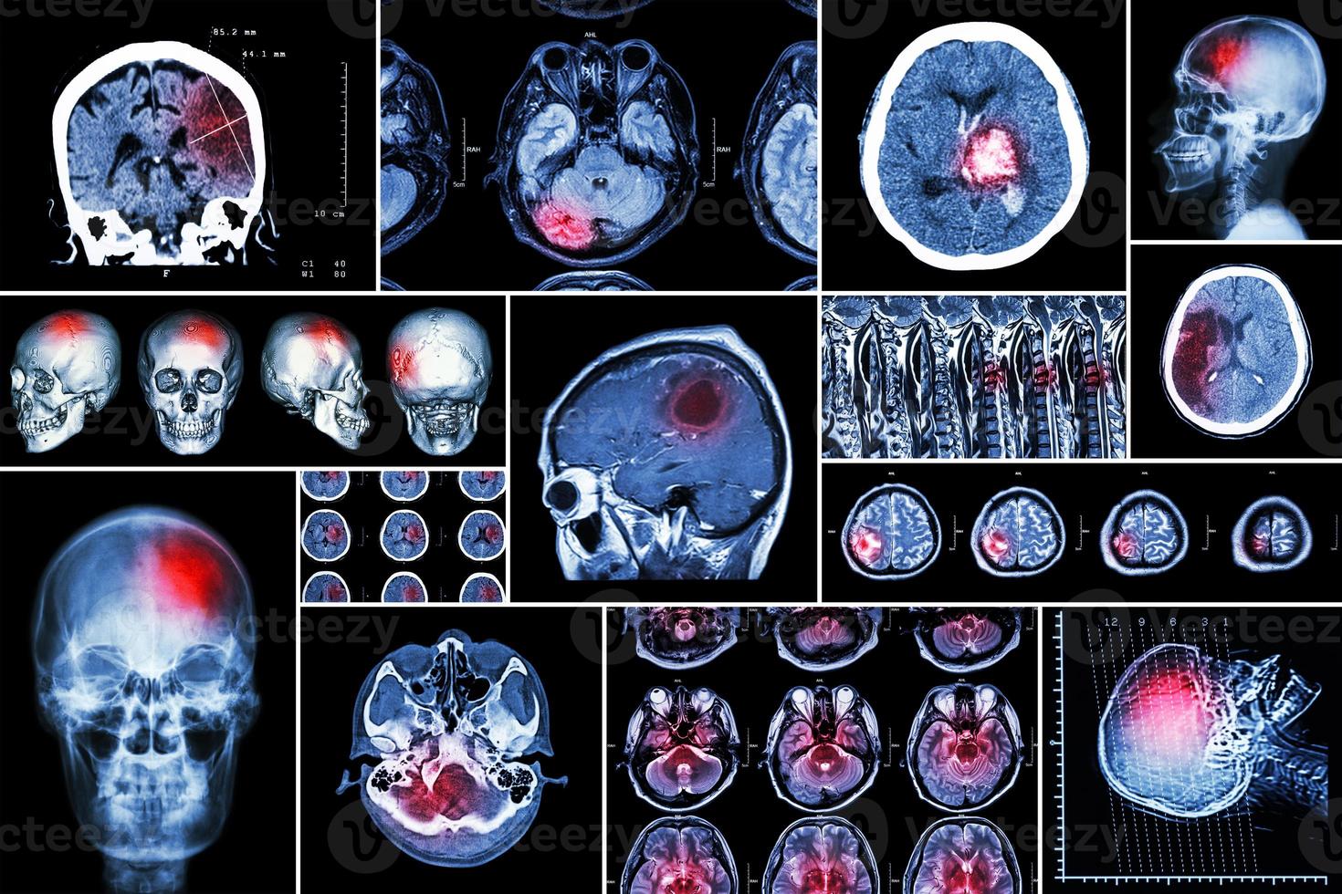 impostare la raccolta di malattie del cervello foto