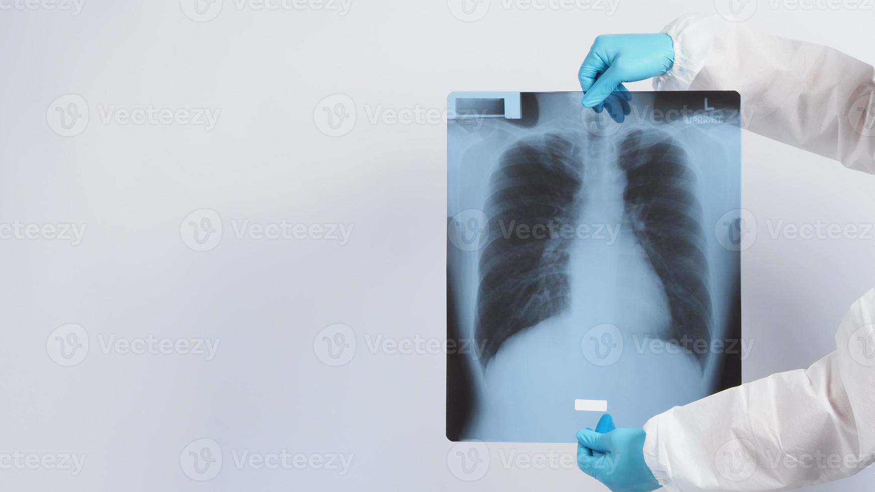 Pellicola a raggi x dei polmoni nelle mani dei medici foto