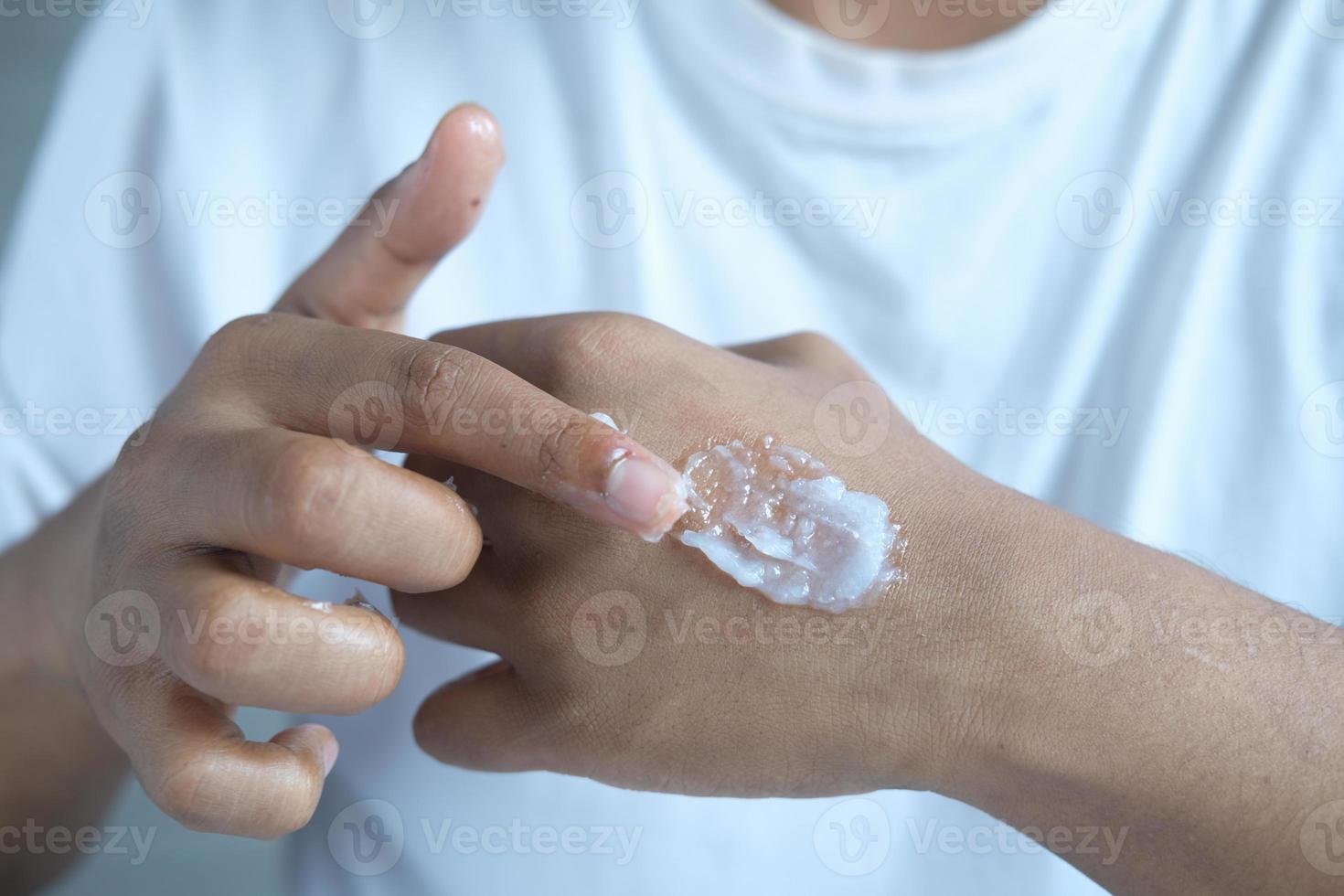 mano d'uomo che applica vaselina sulla pelle foto