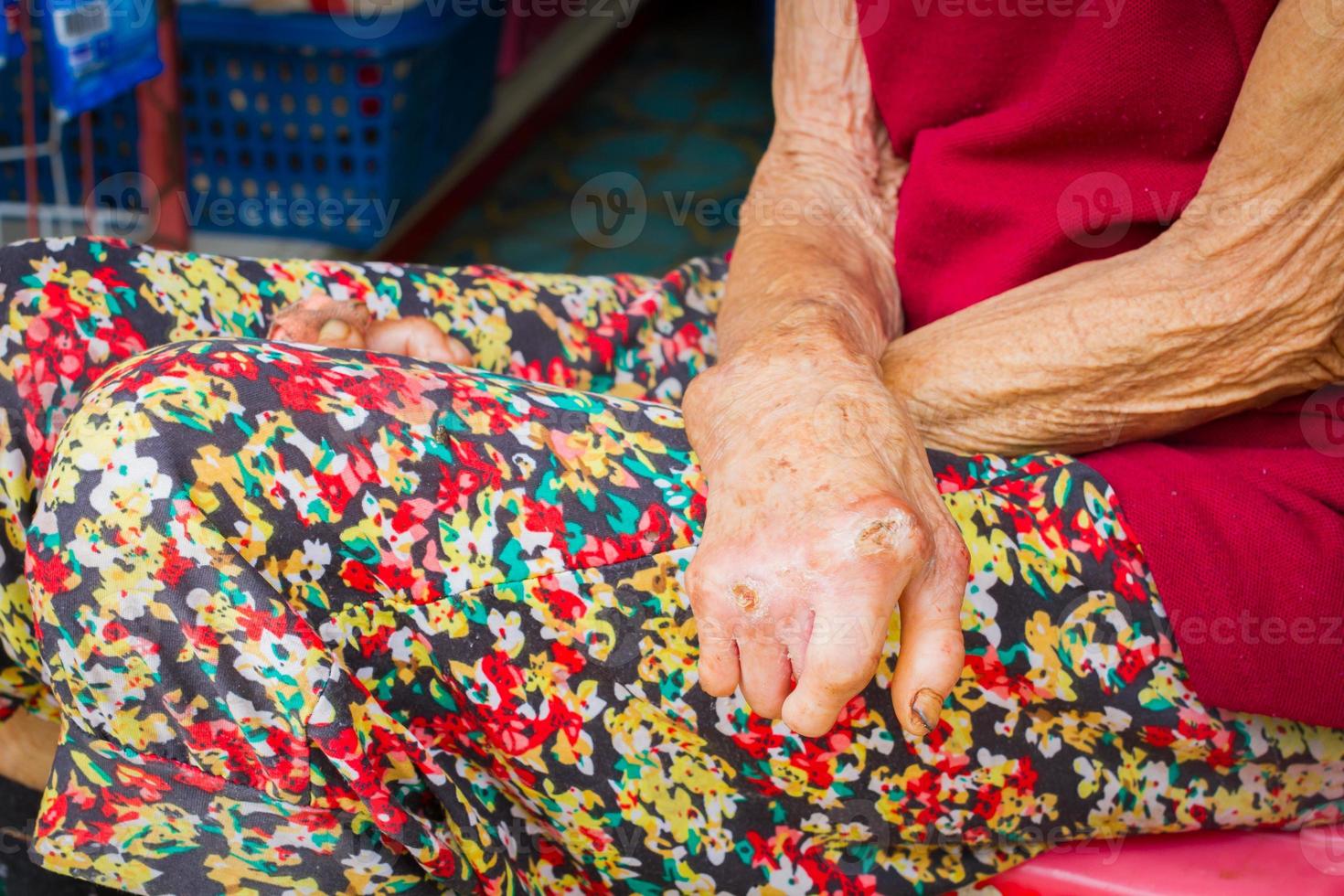 mani del primo piano della donna anziana che soffre di lebbra, mani amputate. foto