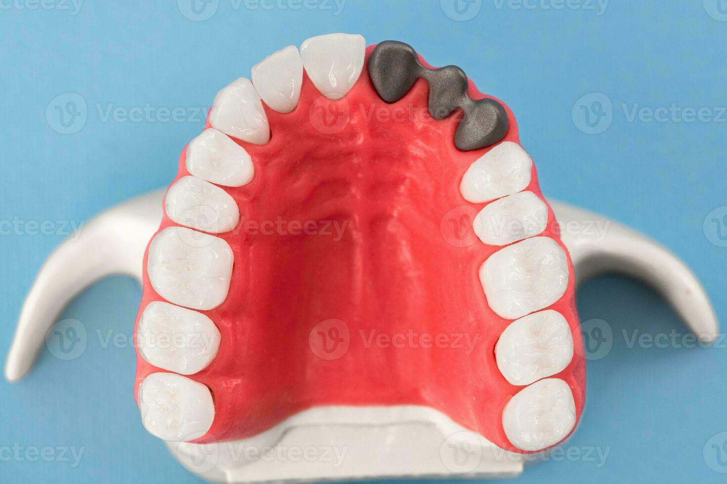 denti impiantare e corona installazione processi parti isolato su un' blu sfondo. medico preciso 3d modello. foto