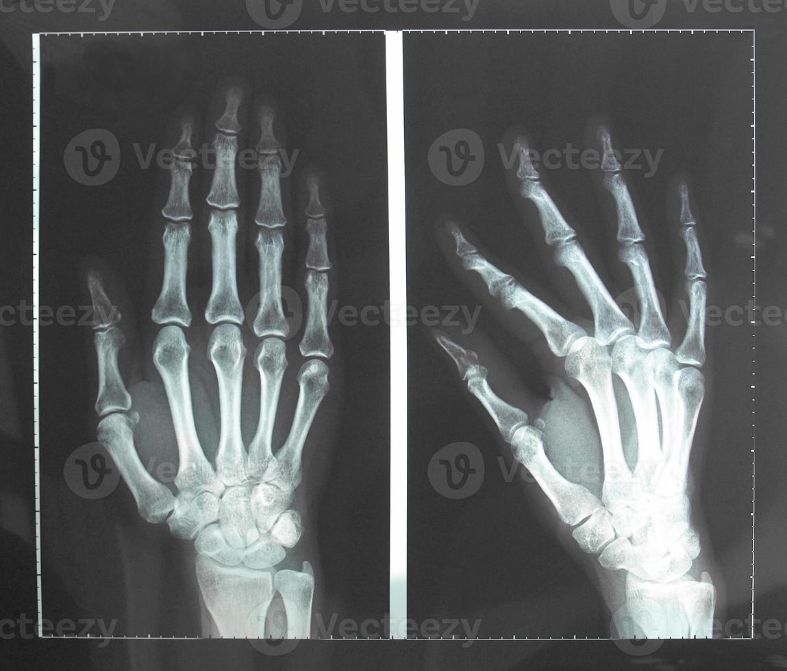 radiografia della mano foto