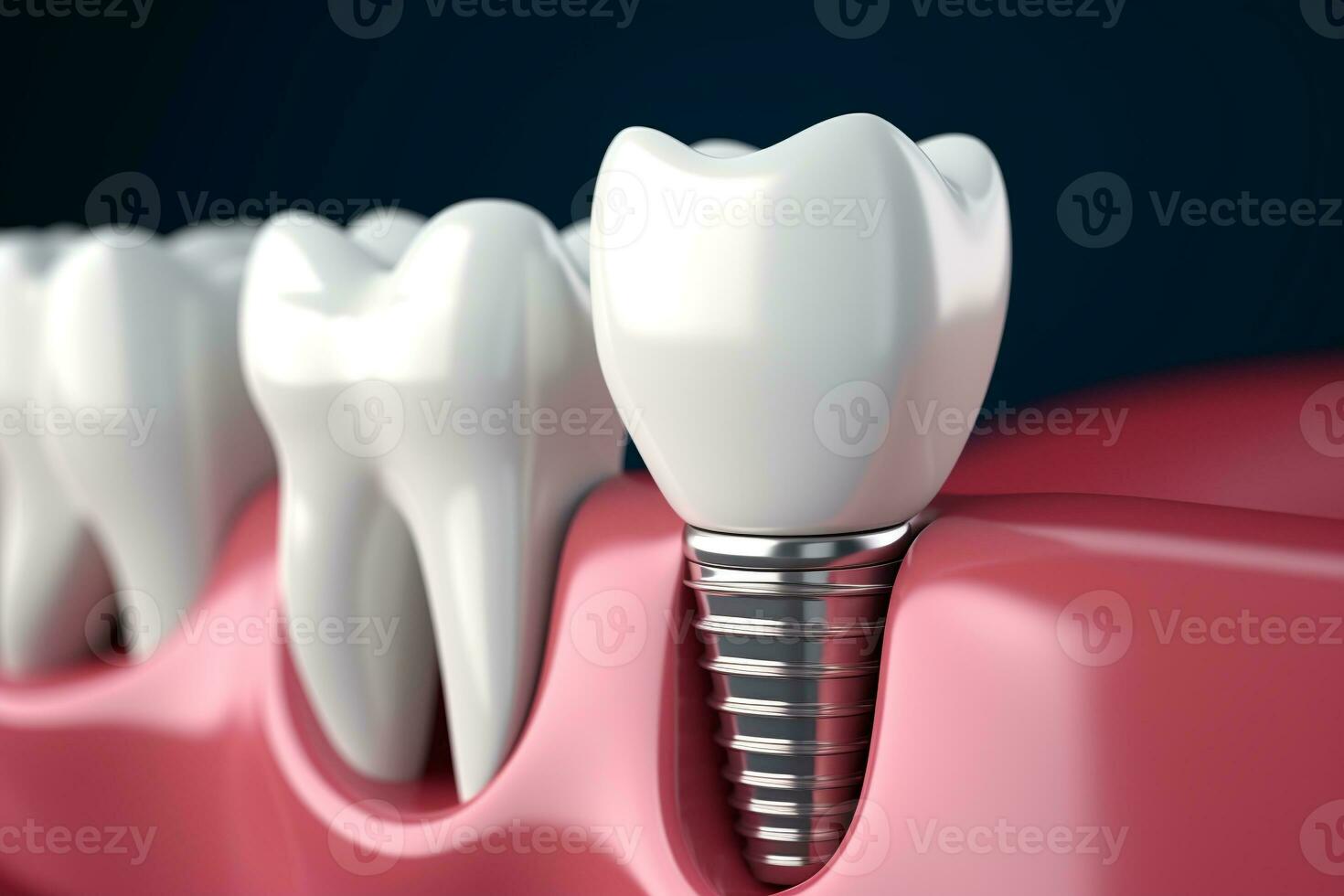 3d generato dentale denti implant.health concetto.creato con generativo ai tecnologia. foto
