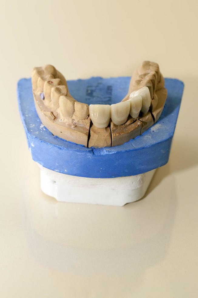 placca dentale in porcellana di zirconio nel negozio del dentista foto