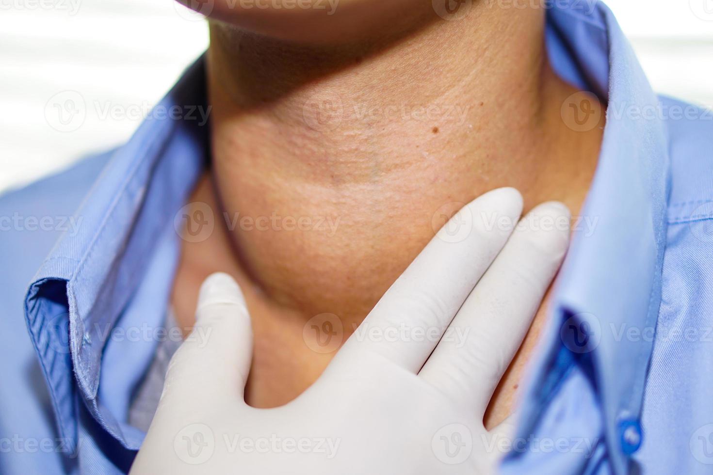 il paziente asiatico ha un ingrossamento anomalo della tiroide alla gola foto