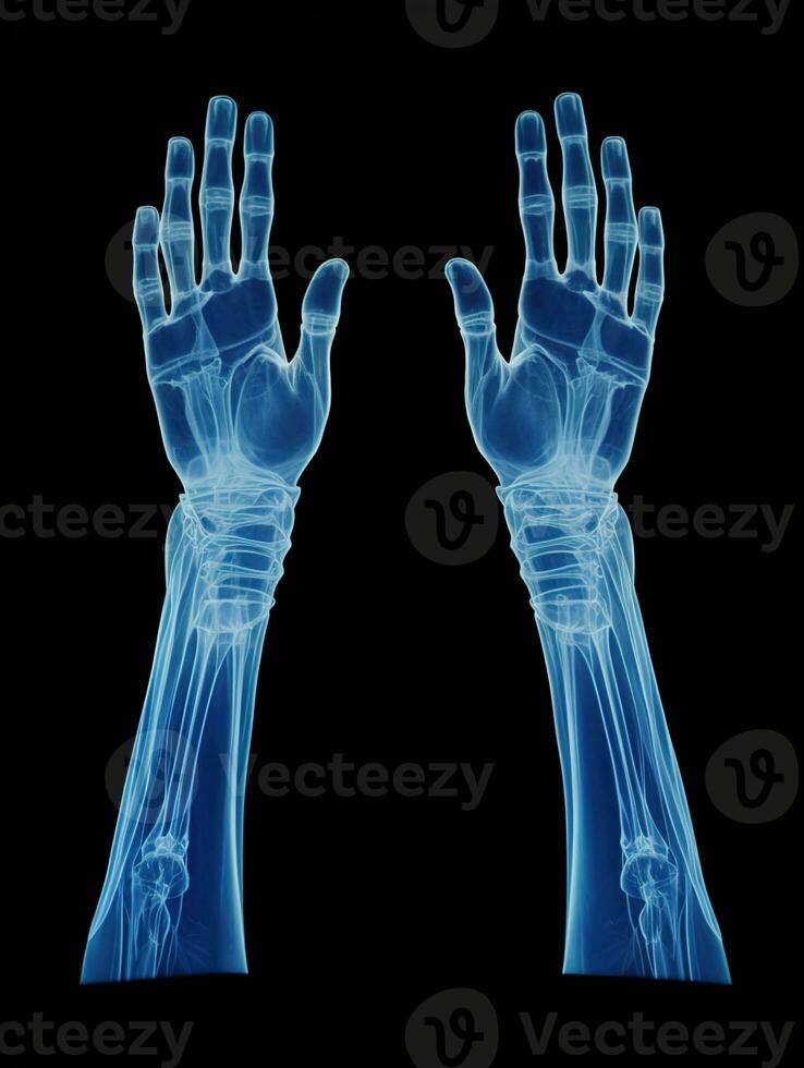 ortopedico eccellenza, dettagliato raggi X di un' maschio umano braccio nel blu toni su un' nero sfondo - ideale per preciso medico l'imaging e diagnosi, ai generativo foto