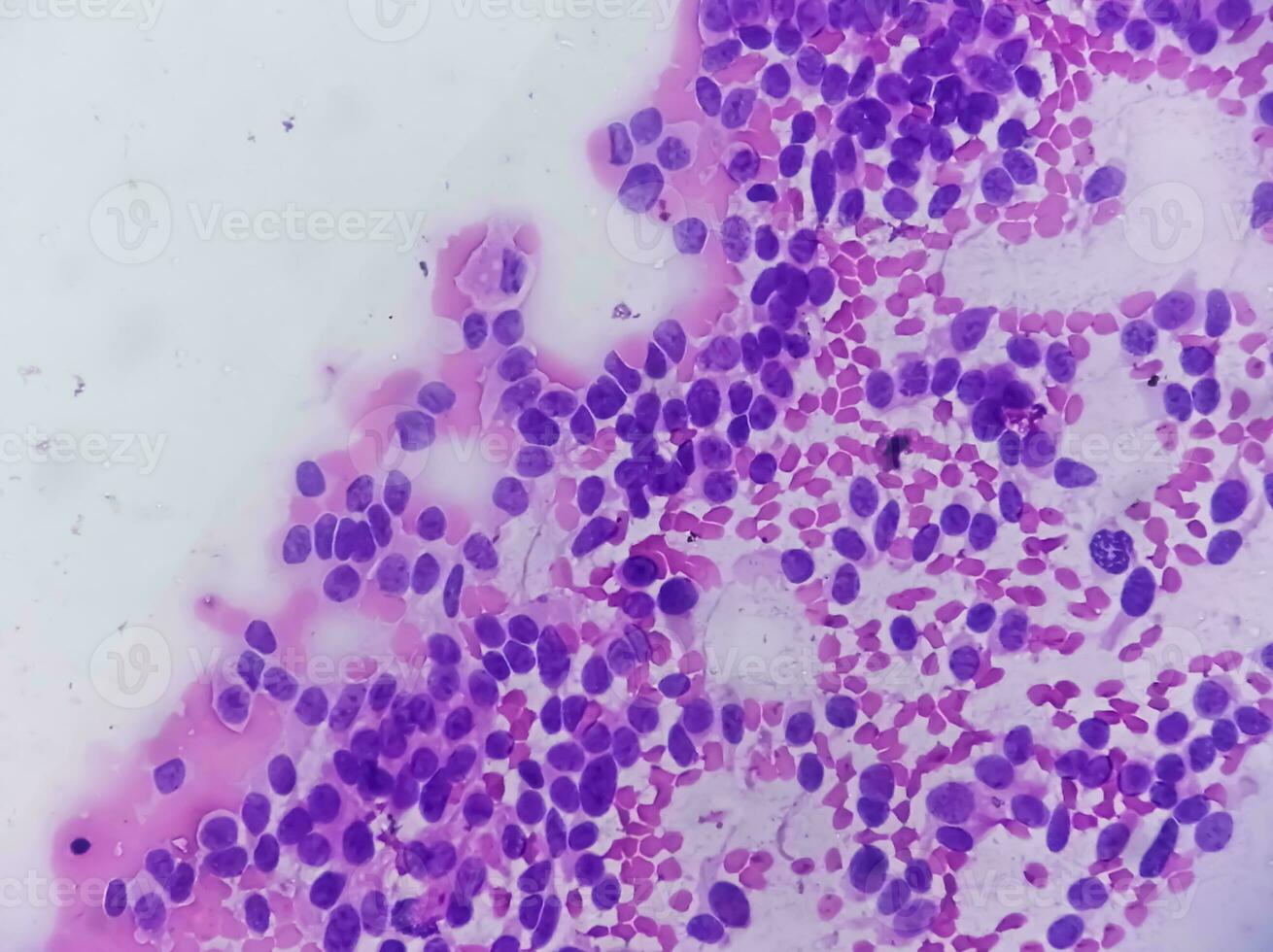usg guidato fna citologia di fegato sol mostrando non Hodgkin linfoma. metastatico carcinoma foto
