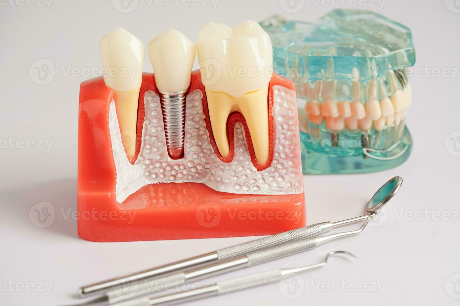 dentale impiantare, artificiale dente radici in mascella, radice canale di dentale trattamento, gomma patologia, denti modello per dentista studiando di odontoiatria. foto