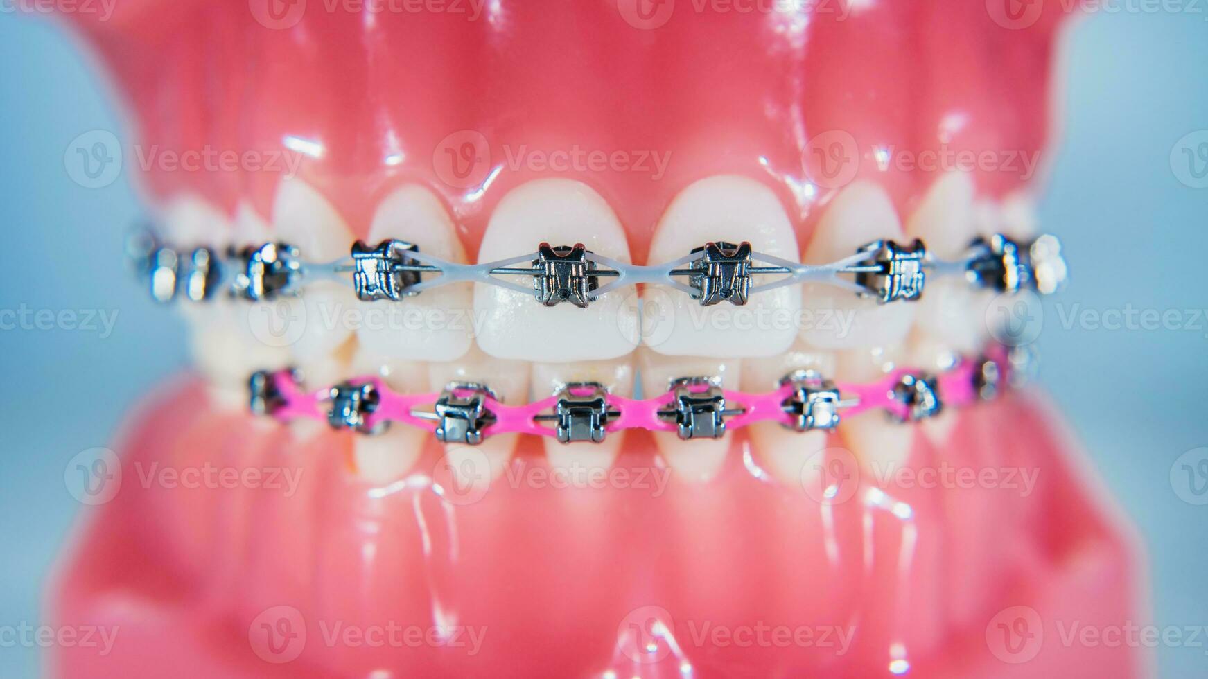 il bretelle siamo posto su il denti nel il artificiale mascella. macro fotografia foto