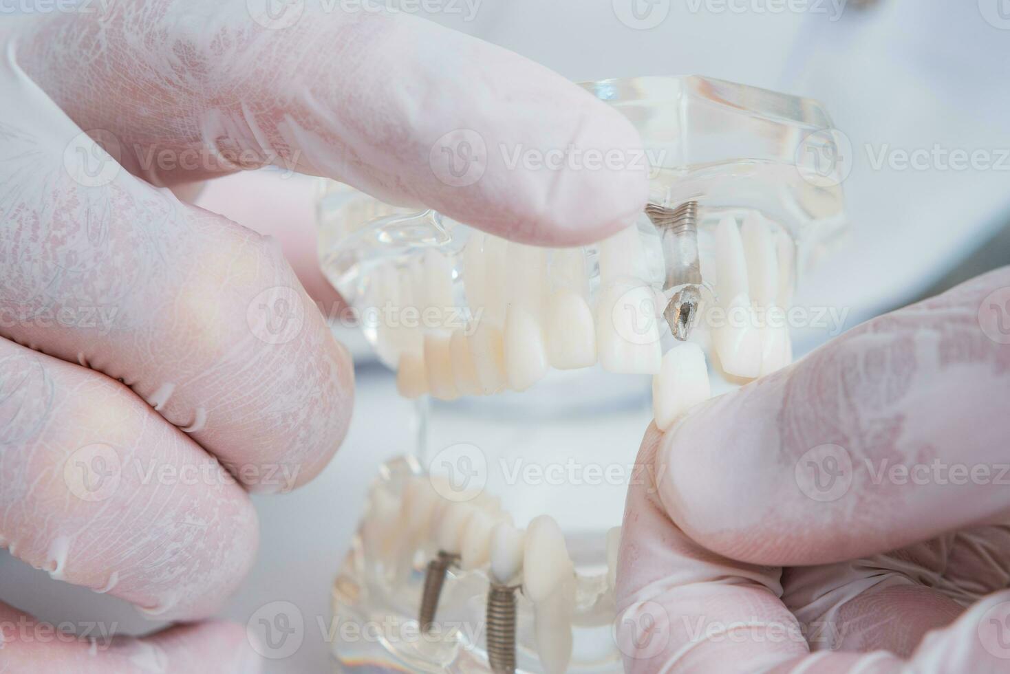 il ortodontista detiene un' modello di denti con impianti nel il suo mano e Spettacoli Come per inserire il dente. vicino su. macro foto