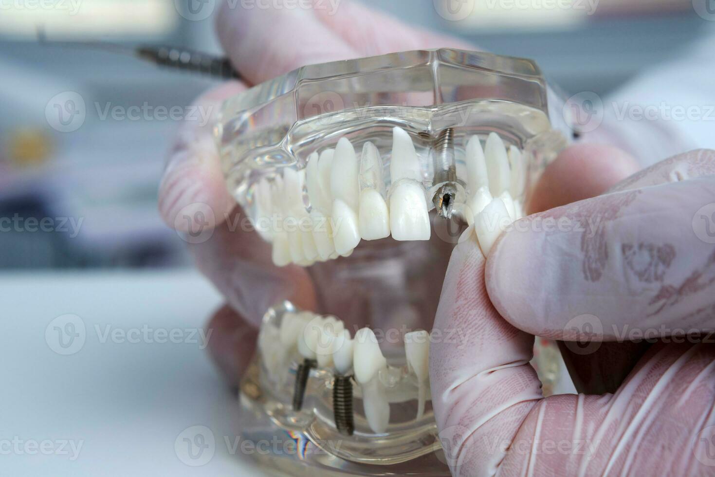 il ortodontista detiene un' modello di denti con impianti nel il suo mano e Spettacoli Come per inserire il dente. vicino su. macro foto