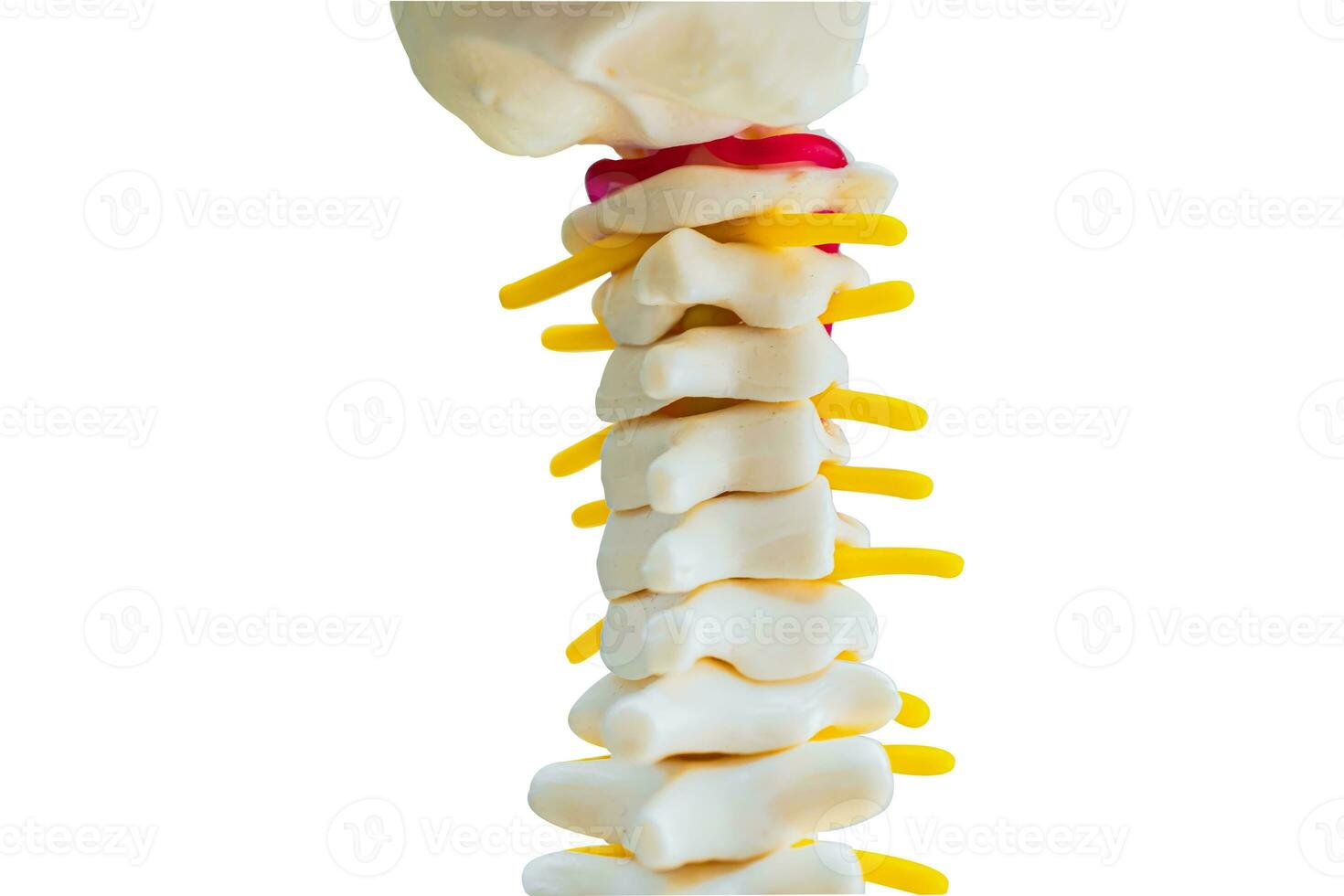 lombare colonna vertebrale sfollati ernia disco frammento, spinale nervo e osso. modello su bianca sfondo con ritaglio sentiero, per trattamento medico nel il ortopedico Dipartimento. foto