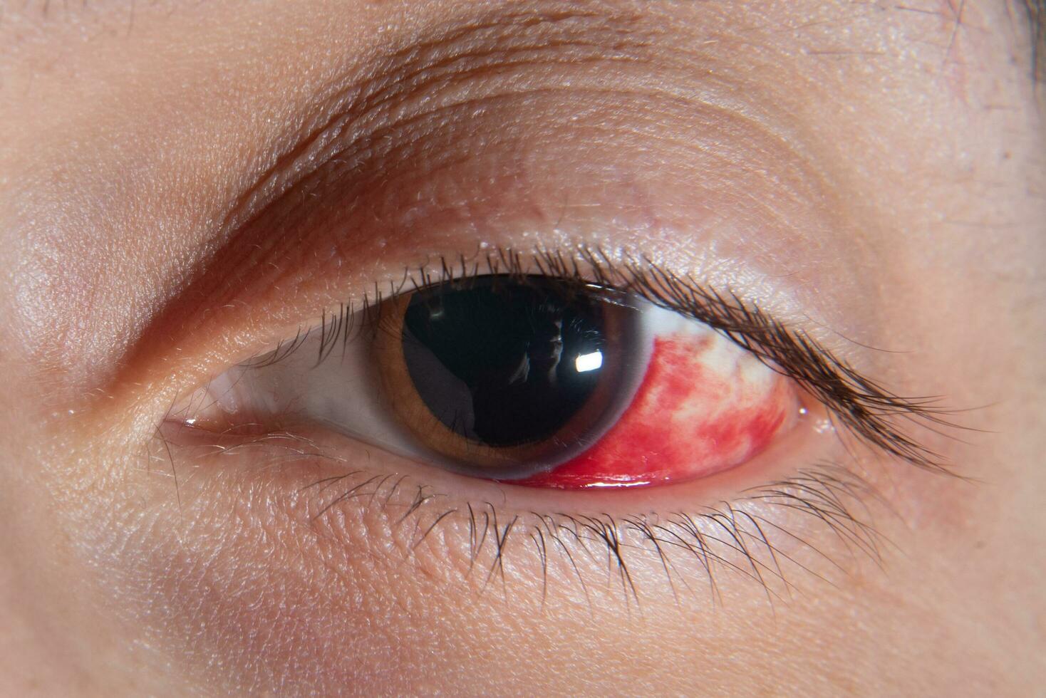 emorragia nel il occhio di un' ragazza. abrasione di il cornea. macro. foto