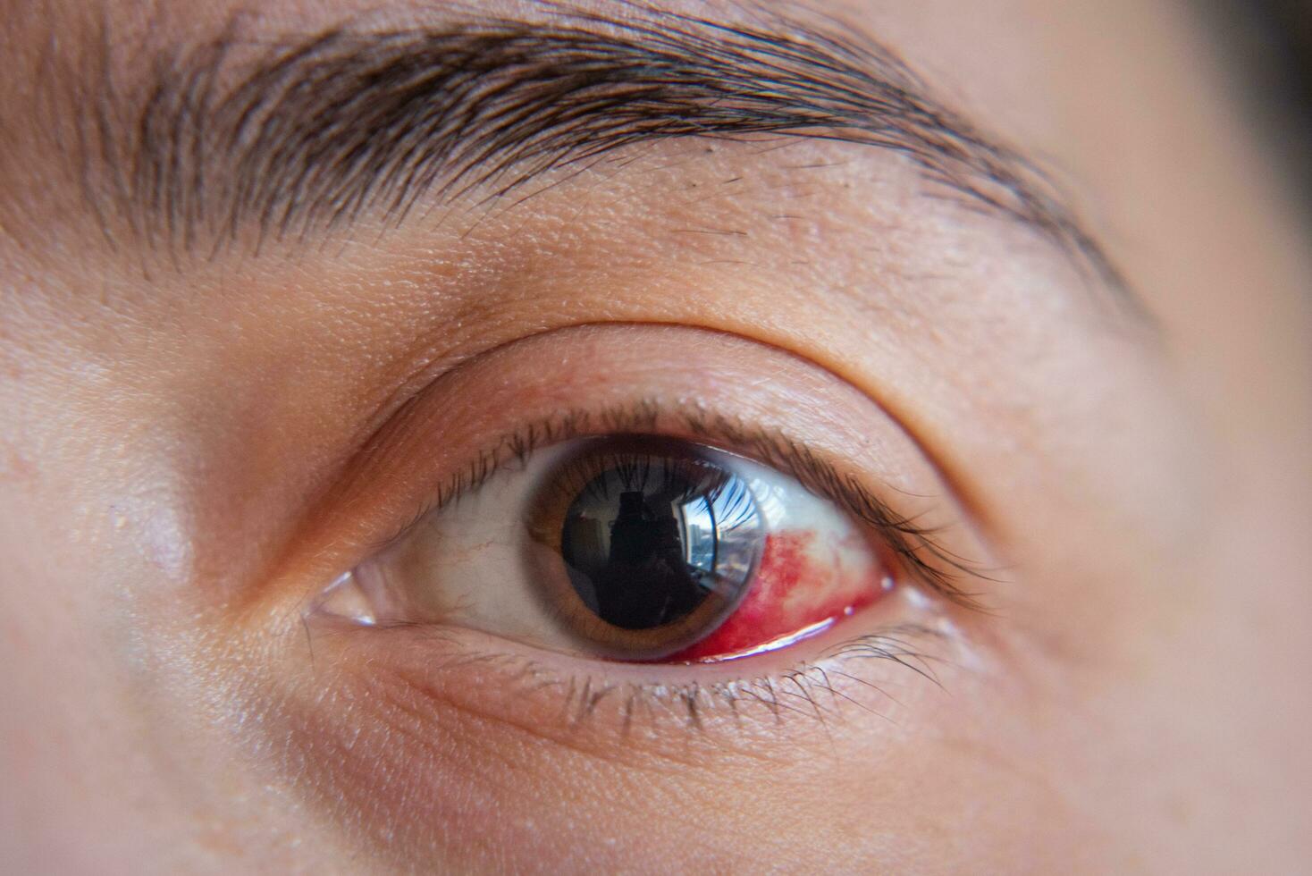 emorragia nel il occhio di un' ragazza. abrasione di il cornea. macro. foto