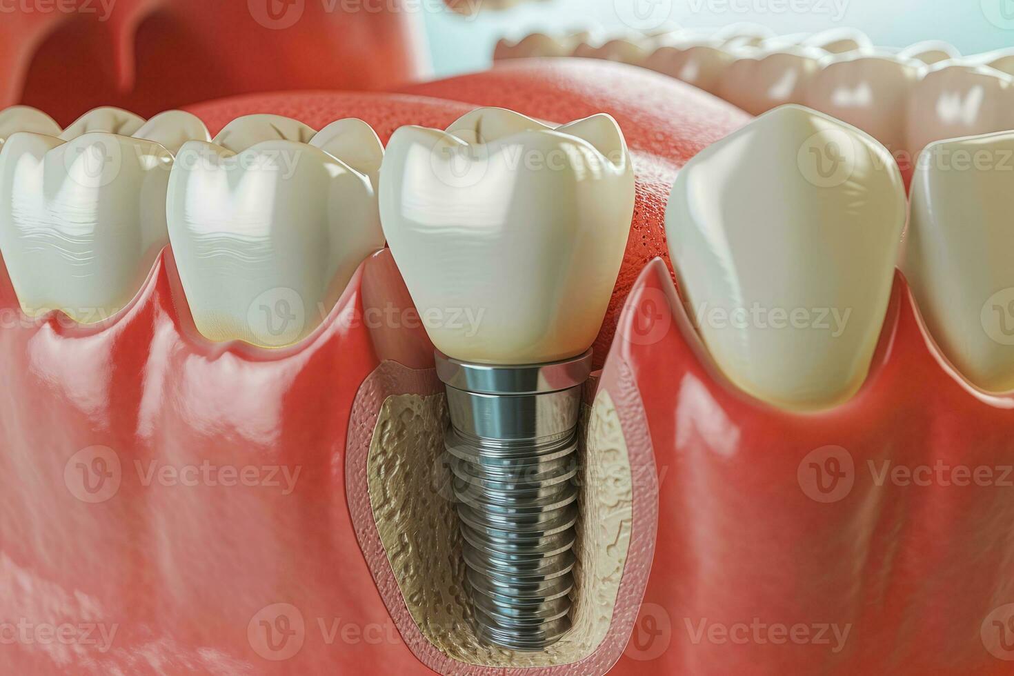 ai generato dente impiantare installato nel mascella. dentale chirurgia foto