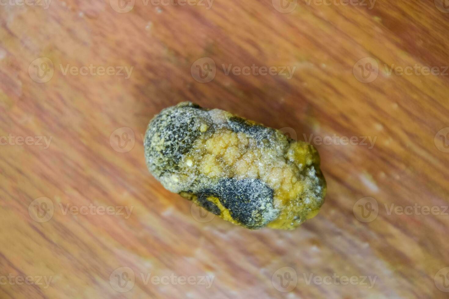 grande calcolo biliare, fiele Vescica urinaria pietra. il risultato di calcoli biliari foto