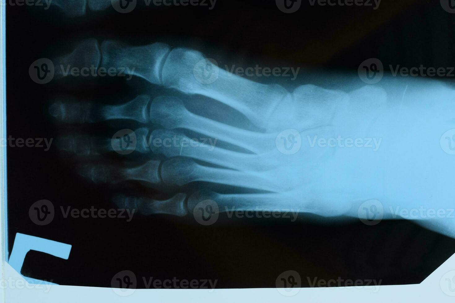 raggi X di le dita dei piedi. piede su raggi X. osso ricerca foto