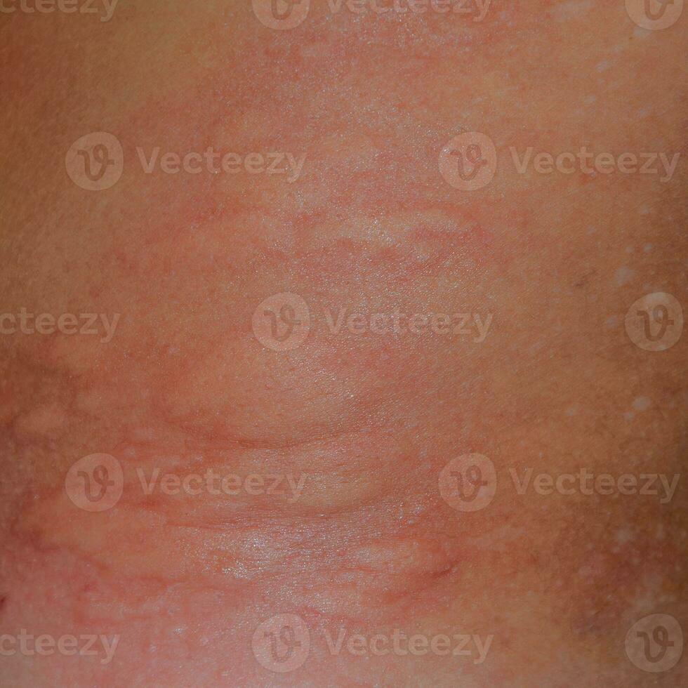 allergia pelle indietro e lati. allergico reazioni su il pelle nel il modulo di rigonfiamento e arrossamento foto