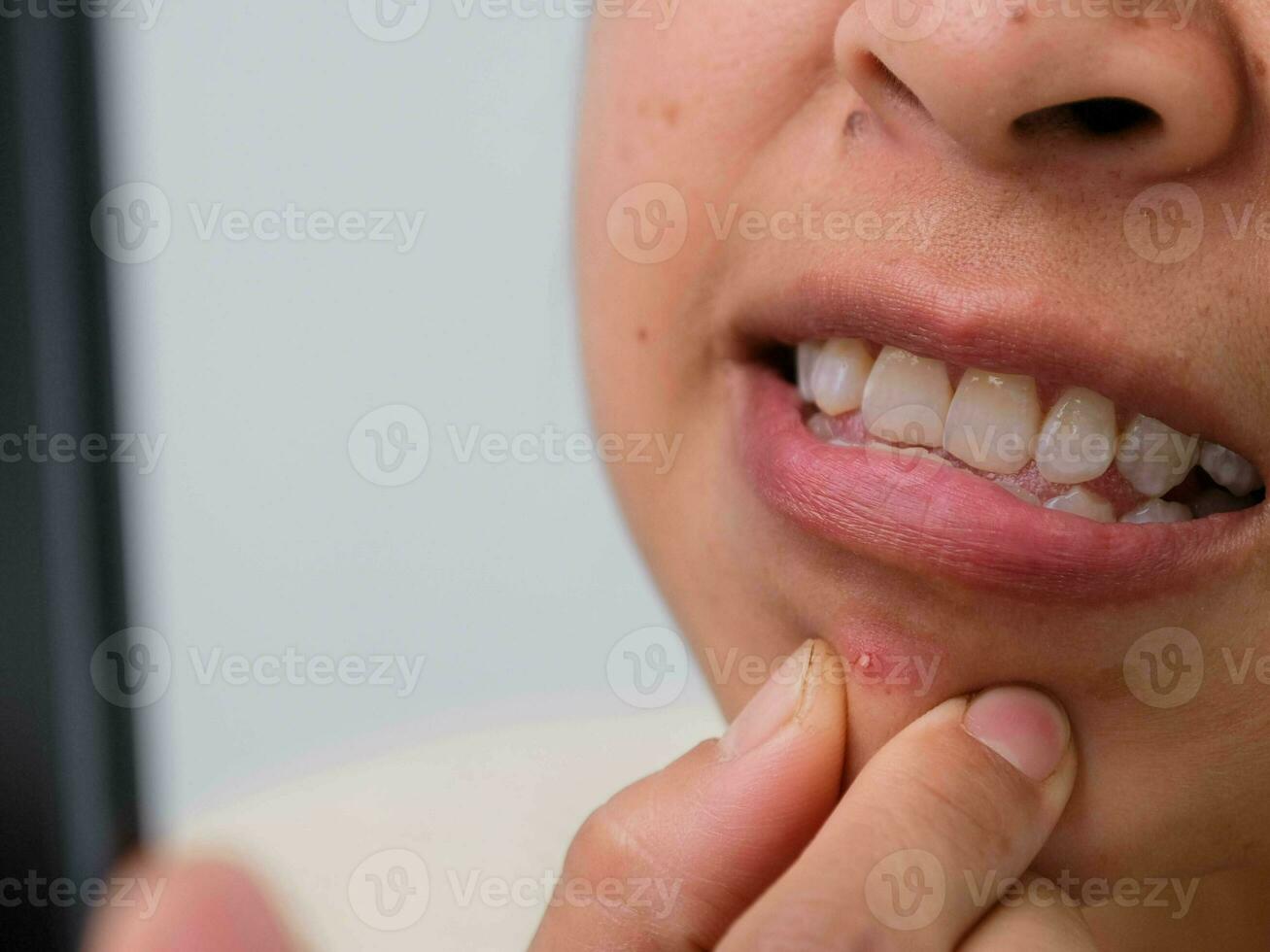 vicino su di giovane donna spremitura brufoli su sua viso. problematico pelle nel dai capelli scuri asiatico donna. concetto di pelle i problemi e pelle cura. foto