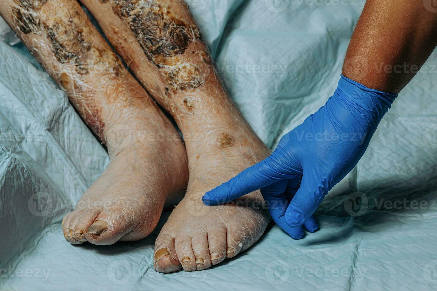 su il gambe di un anziano donna, il pelle bucce via dovuto per eczema, rigonfiamento di il gambe. ingiallimento di il chiodo piatto. rigonfiamento di il gambe. conseguenze di diabete nel il anziano. anziano cura foto