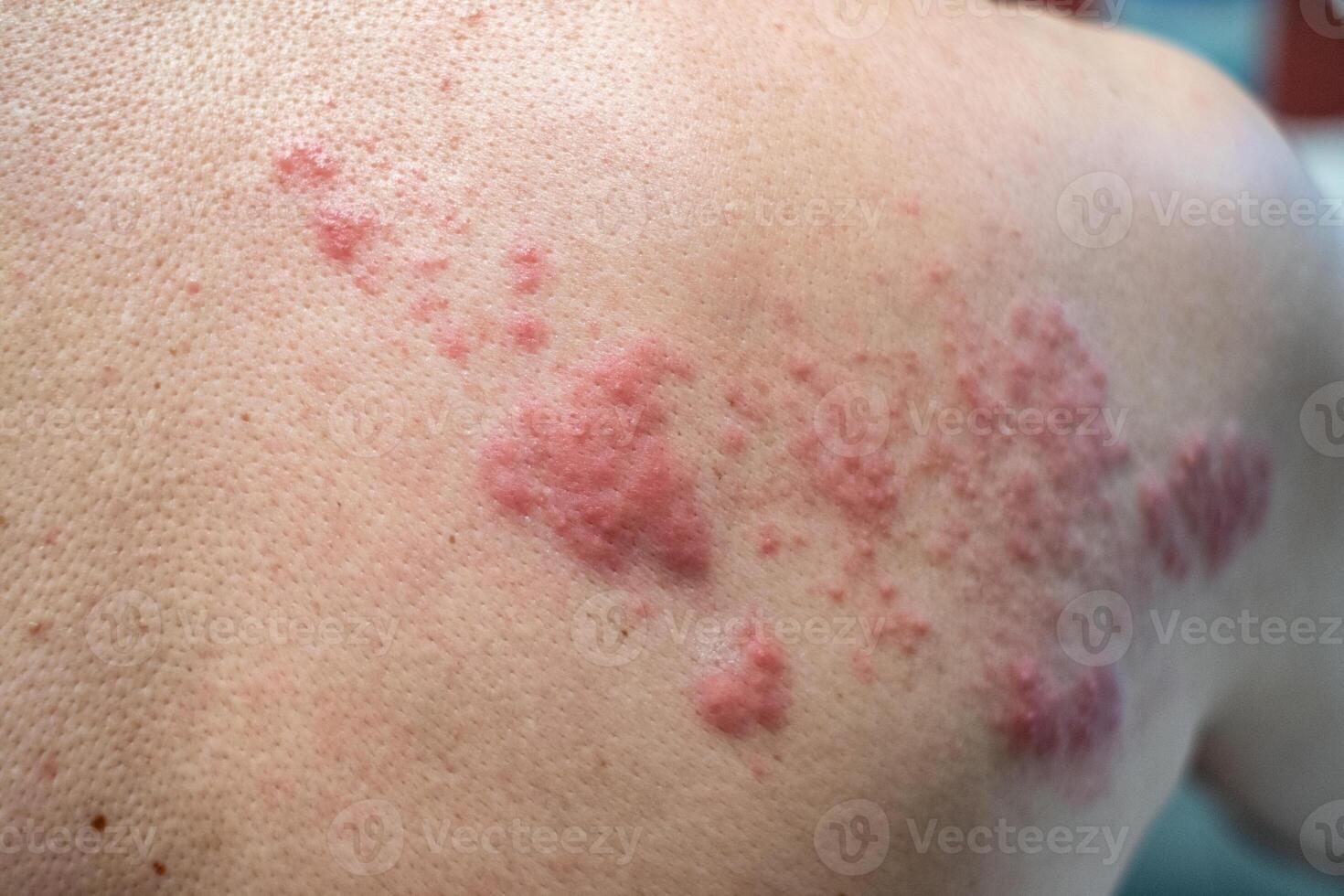 herpes zoster patologia, erpete zoster, varicella-zoster virus. pelle eruzione cutanea e vesciche foto