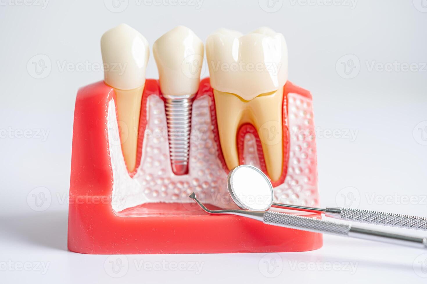 dentale impiantare, artificiale dente radici in mascella, radice canale di dentale trattamento, gomma patologia, denti modello per dentista studiando di odontoiatria. foto