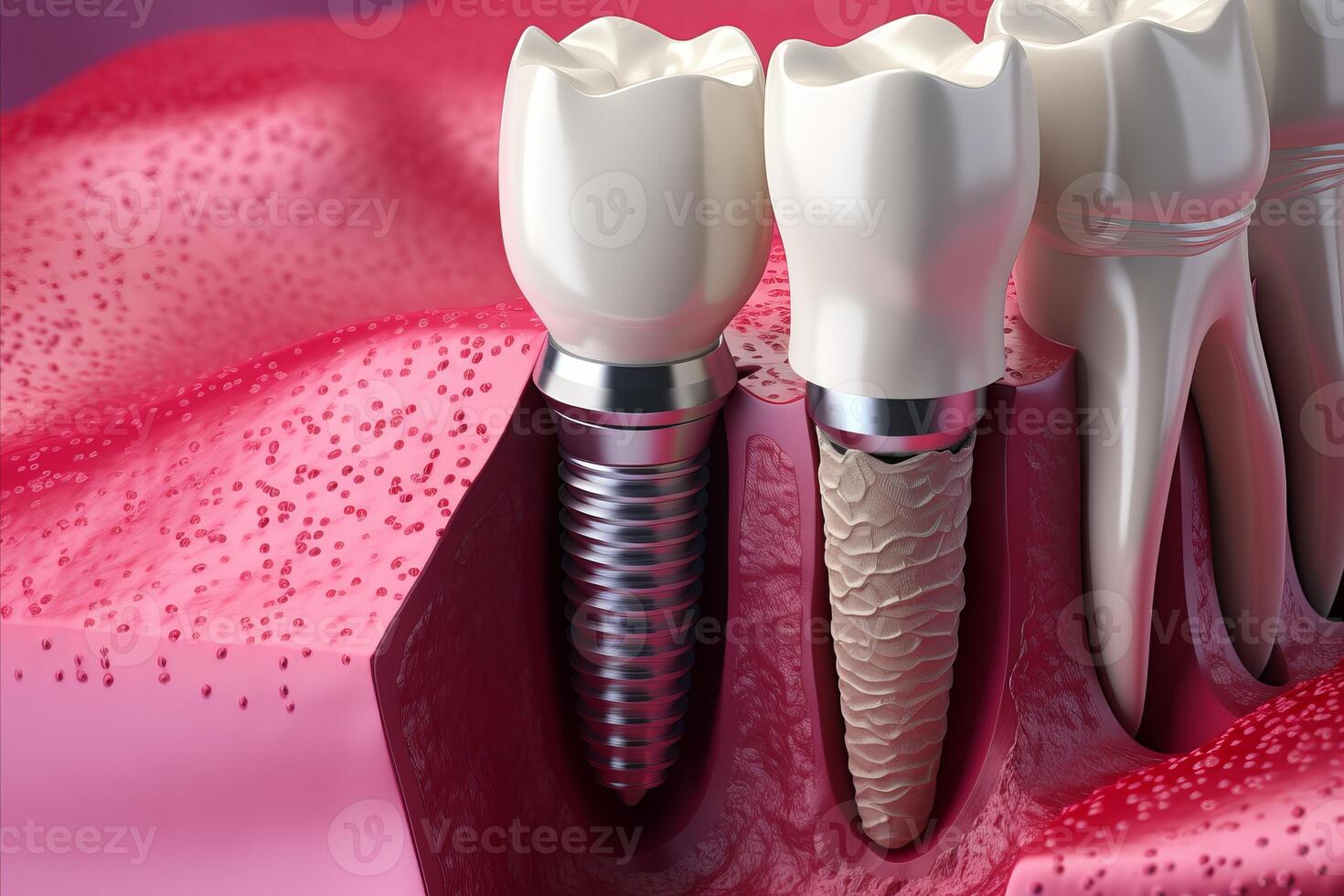 ai generato dettagliato dentale impiantare adattamento illustrazione, in mostra preciso tecnica e competenza foto