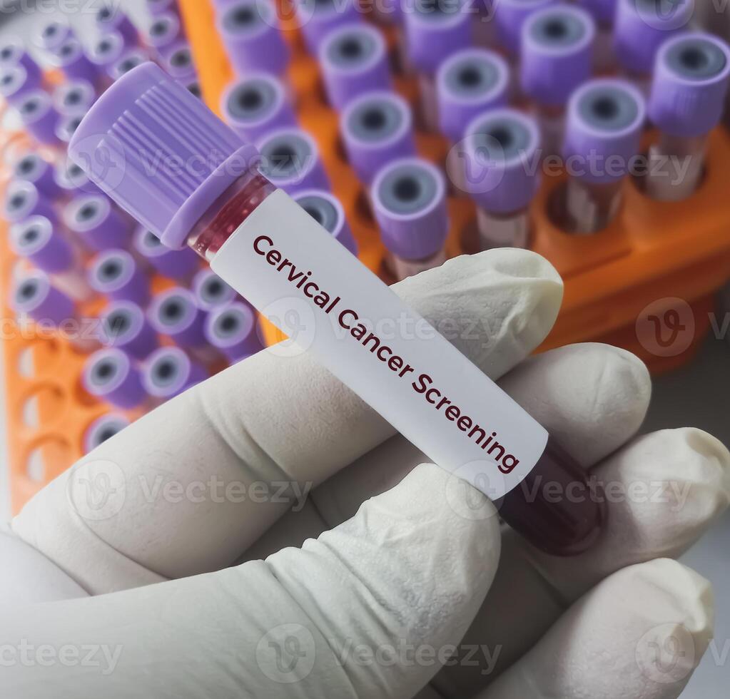 sangue campione per cervicale cancro selezione o co-test, umano papilloma virus, cervicale cancro. un' medico analisi concetto nel il laboratorio foto