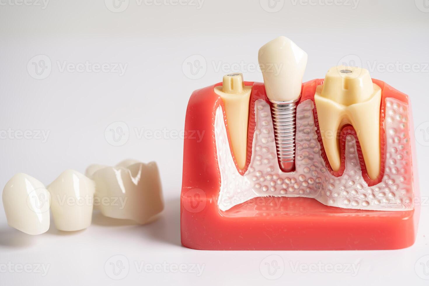 dentale impiantare, artificiale dente radici in mascella, radice canale di dentale trattamento, gomma patologia, denti modello per dentista studiando di odontoiatria. foto