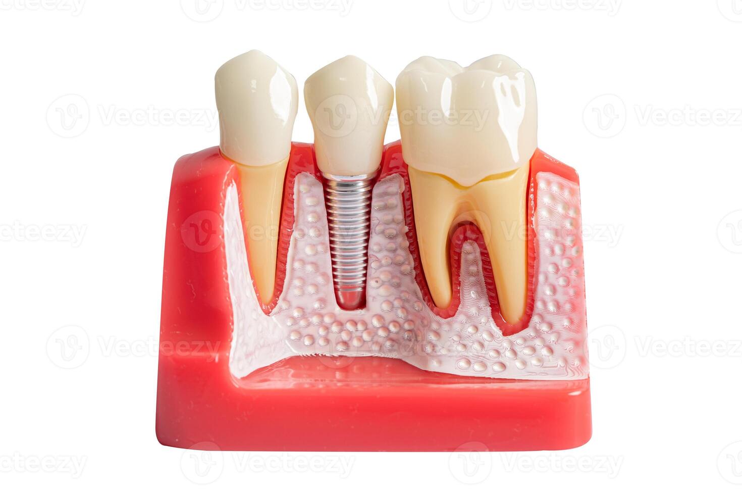 dentale impiantare, artificiale dente radici in mascella, radice canale di dentale trattamento, gomma malattia su bianca sfondo con ritaglio sentiero, denti modello per dentista studiando di odontoiatria. foto