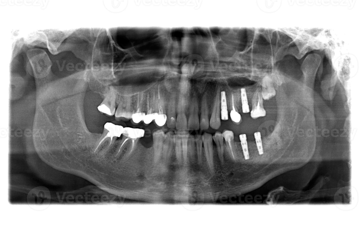 X raggio di denti foto