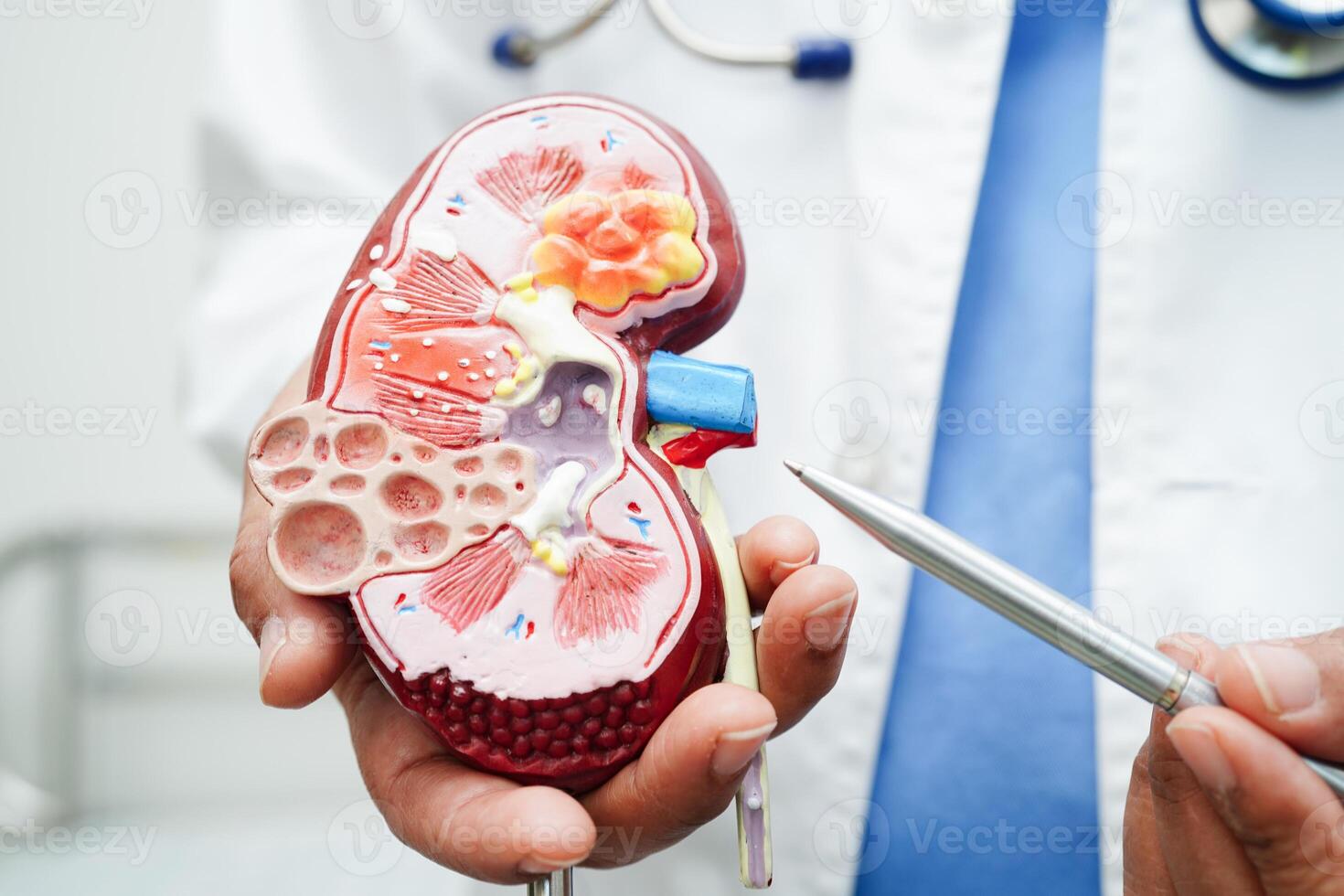 cronico rene patologia, medico con modello per trattamento urinario sistema, urologia, stimato glomerulare filtrazione Vota egfr. foto