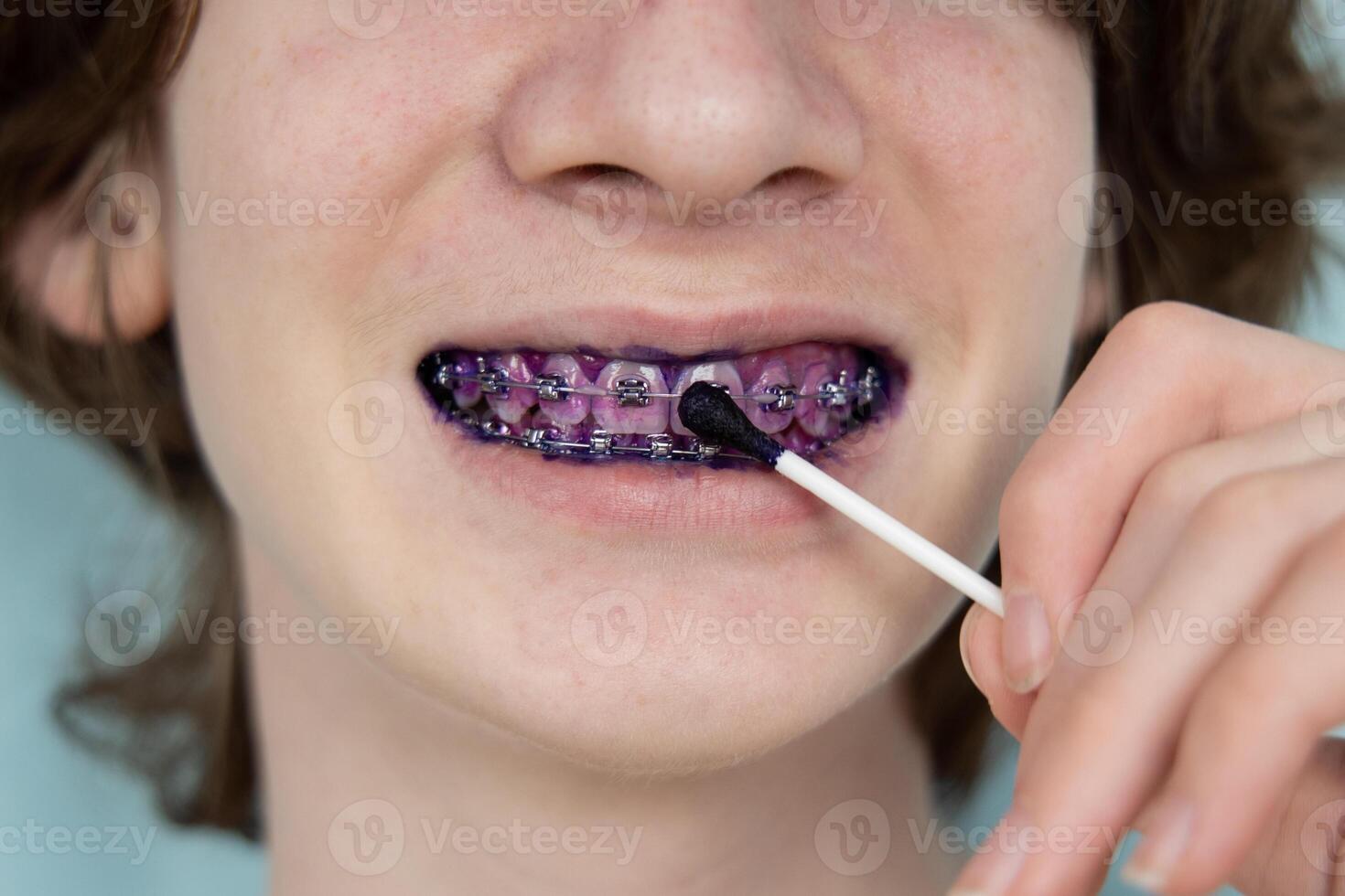 placca indicatore su umano denti con bretelle. placca è colorato rosa. adolescente utilizzando placca indicatore gel. denti cura. foto