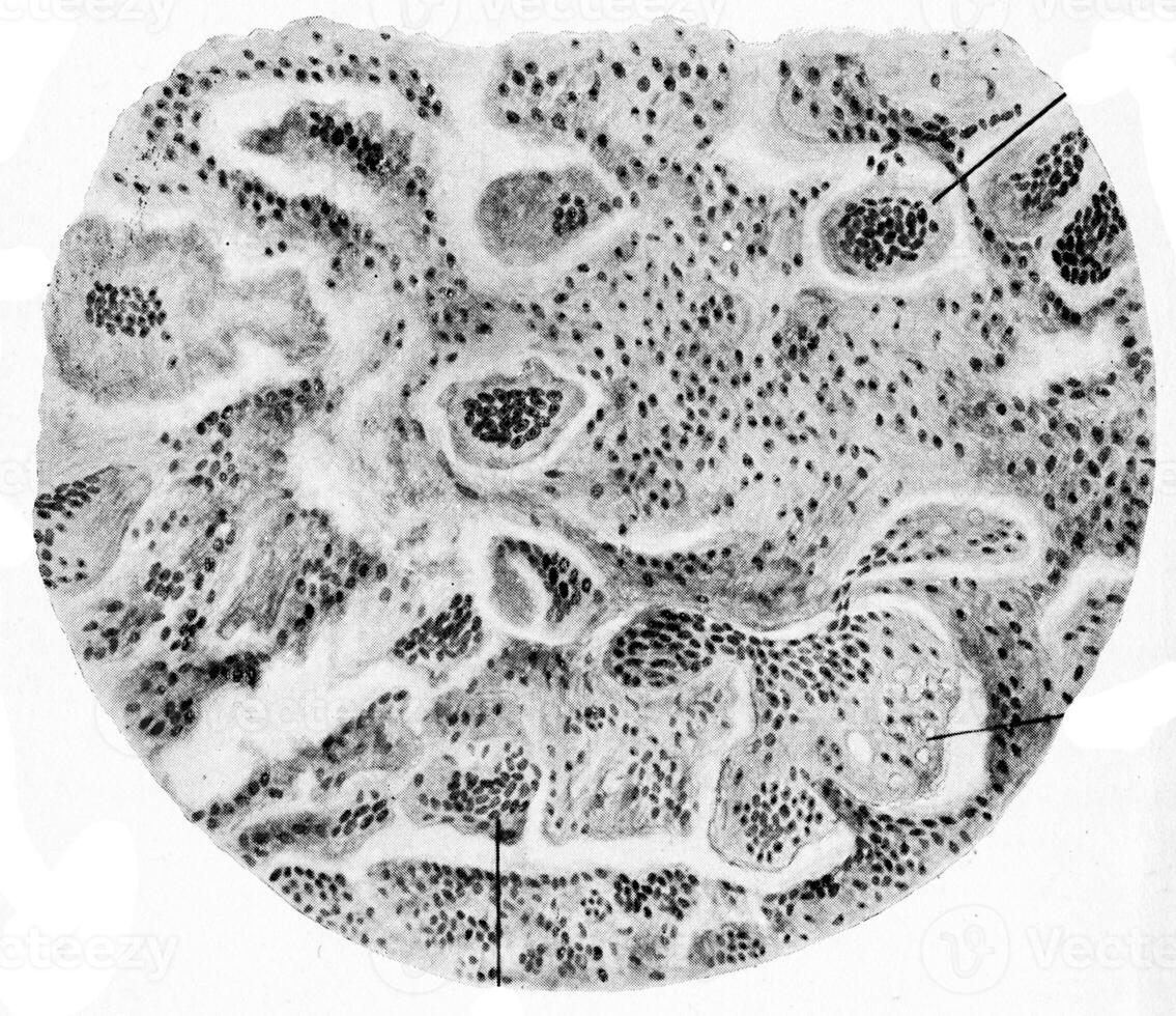 gigante cellula sarcoma, Vintage ▾ incisione. foto