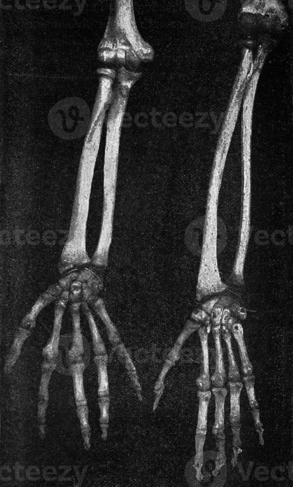 scheletro di il avambraccio e mano di un' giapponese e un australiano, Vintage ▾ incisione. foto