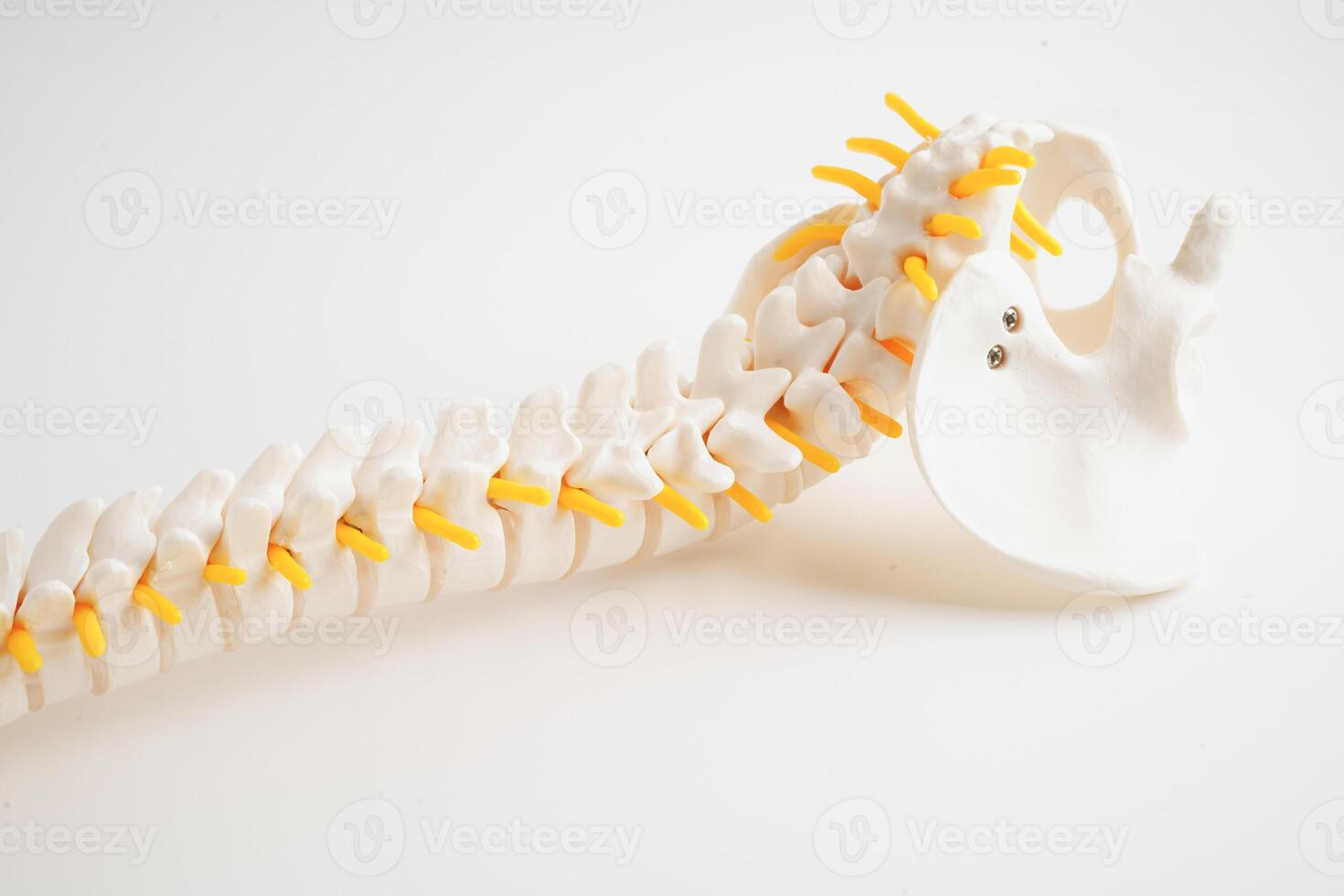 spinale nervo e osso, lombare colonna vertebrale sfollati ernia disco frammento, modello per trattamento medico nel il ortopedico Dipartimento. foto