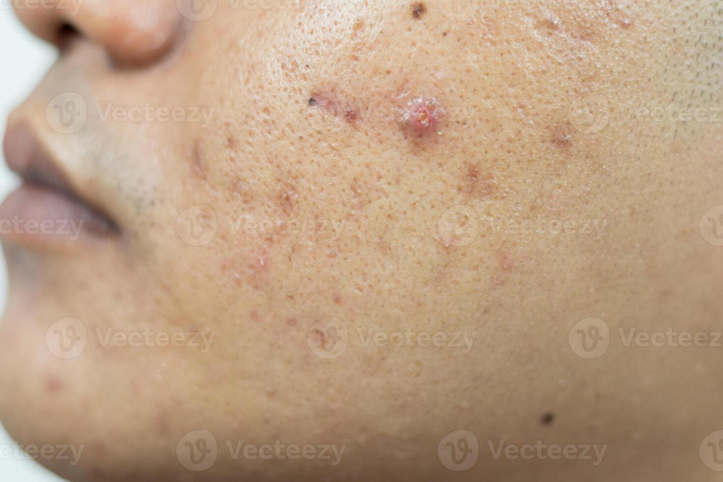 pelle i problemi. problema di infiammato acne su il viso. infiammato acne consiste di rigonfiamento, arrossamento, e pori quello siamo gravemente intasato con batteri, olio, e morto pelle cellule. foto