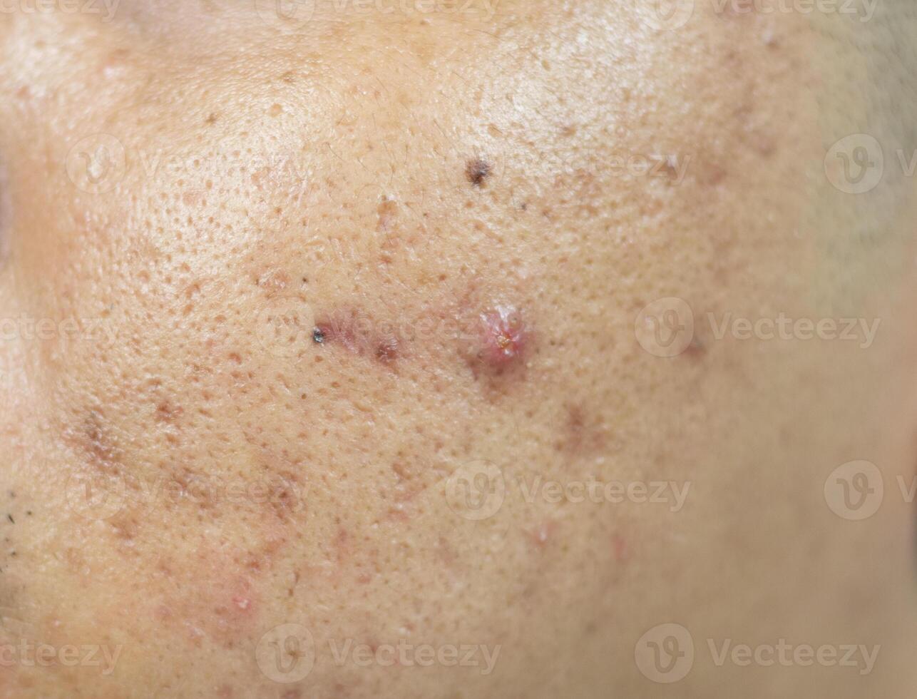 pelle i problemi. problema di infiammato acne su il viso. infiammato acne consiste di rigonfiamento, arrossamento, e pori quello siamo gravemente intasato con batteri, olio, e morto pelle cellule. foto