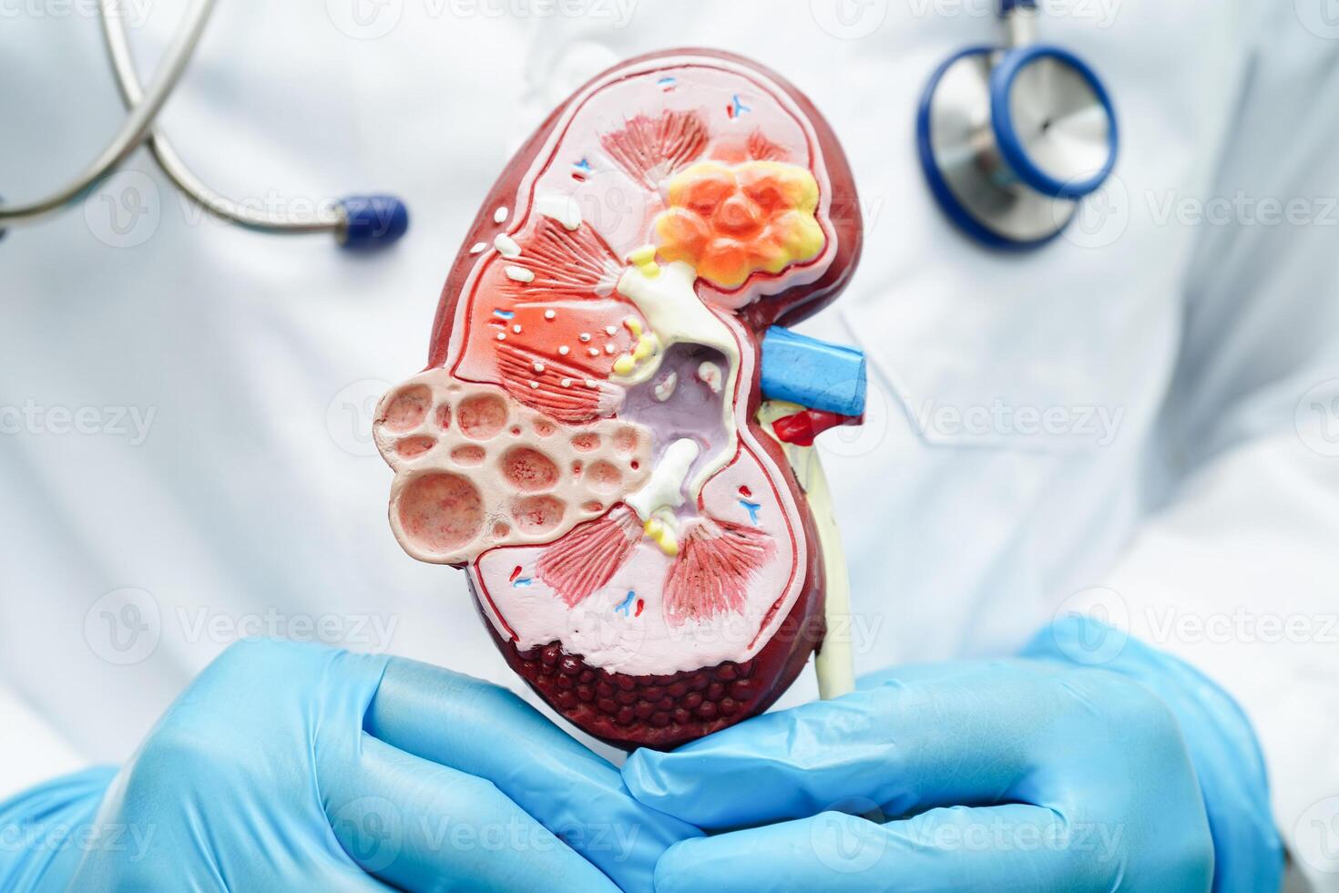 cronico rene patologia, medico con modello per trattamento urinario sistema, urologia, stimato glomerulare filtrazione Vota egfr. foto