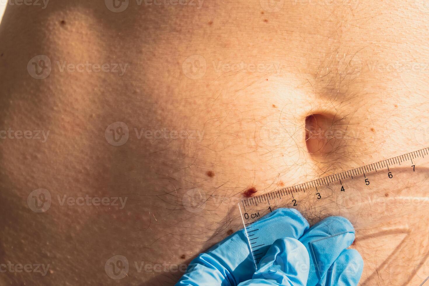 dermatologo controllo dimensioni di maschio voglie con governate. medico l'esame lunghezza e larghezza di benigno nei su uomo pelle pigmentazione. foto