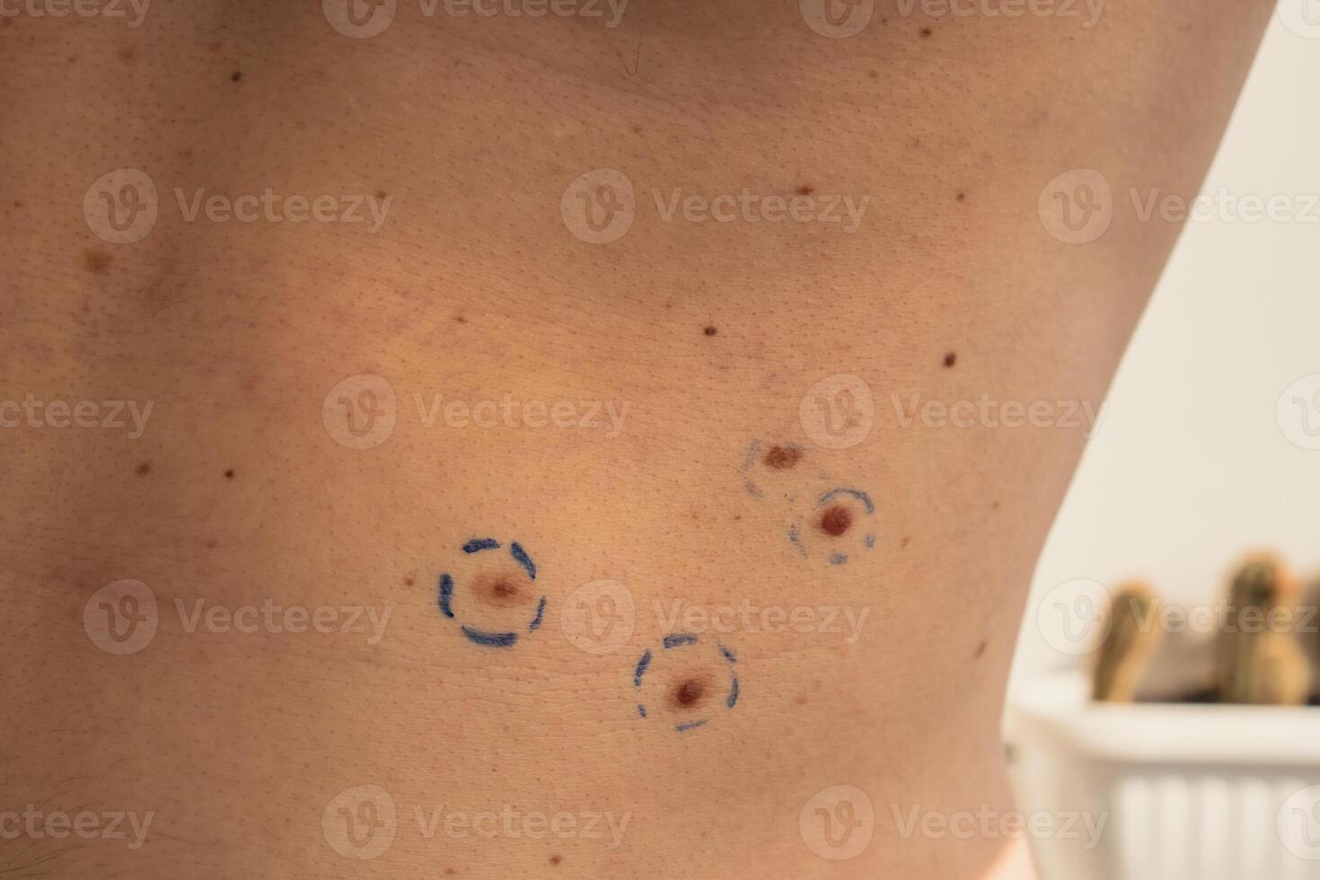 medico nel medico guanti dipingere Linee in giro maschio voglie. preparazione procedura per medico chirurgia. laser pelle tag rimozione. prevenzione di melanoma e nevo esame foto