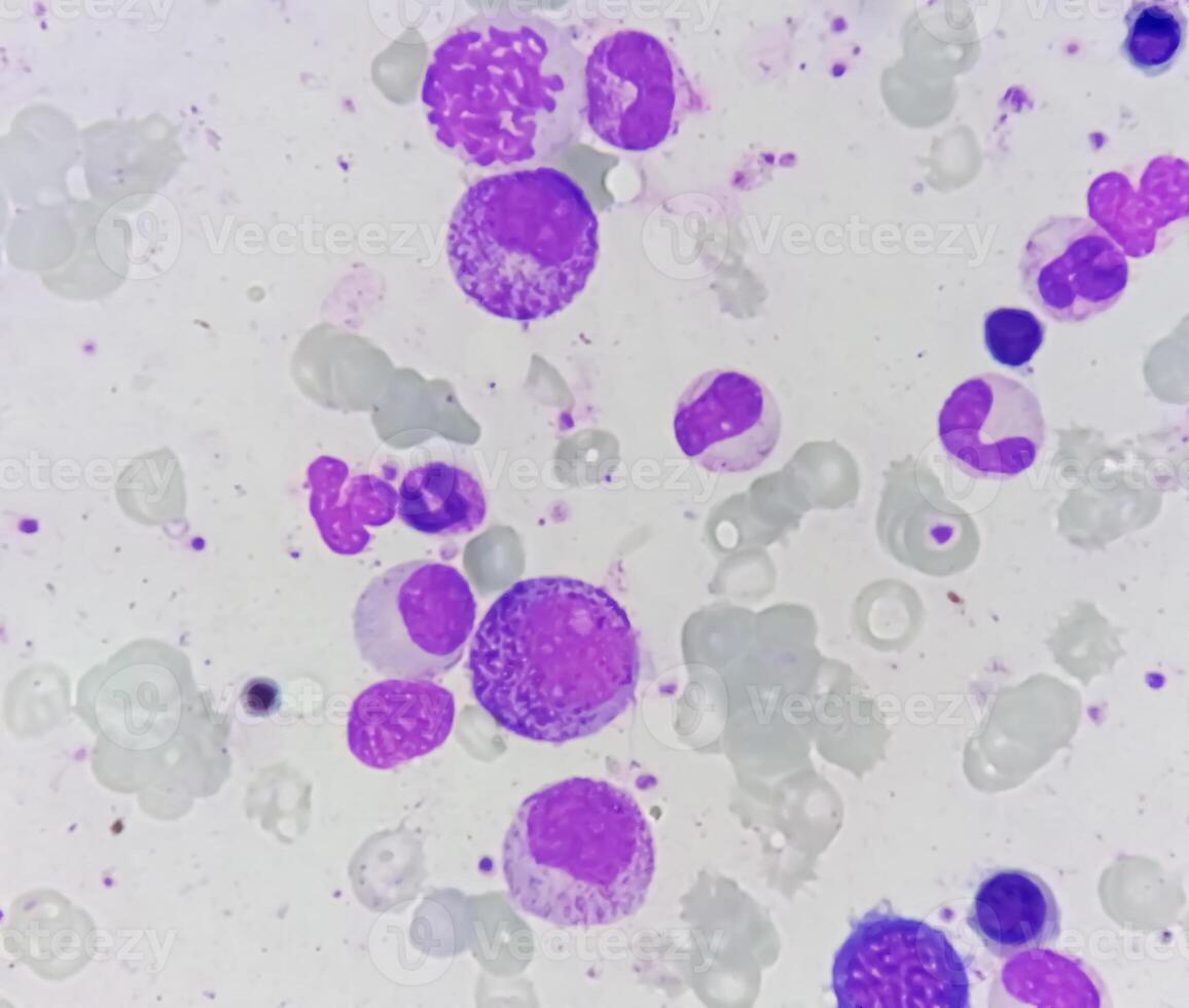 osso midollo studia, suggestivo di reattivo midollo con dimorfico eritroide iperplasia foto