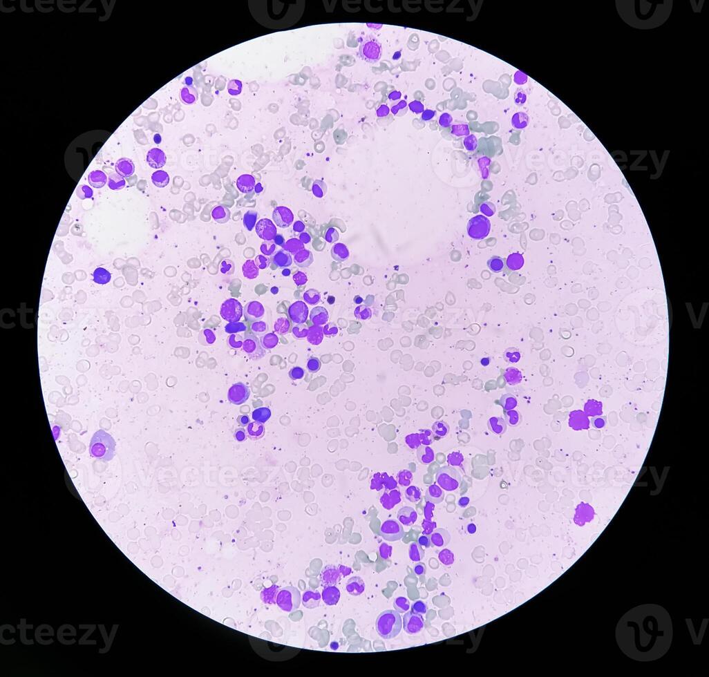 osso midollo studia, suggestivo di reattivo midollo con dimorfico eritroide iperplasia foto